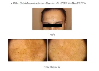 Kem Nám Ivawhite Whitening Cream - Hỗ Trợ Trắng Da, Giảm Nám, Tàn Nhang, Chất Lượng Cao, Dành Cho Da Nhạy Cảm 50ml