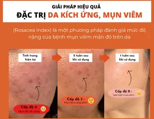 Toner Pad Bellamonster Carrot - Dành cho Da Mụn & Nhạy Cảm, Giúp Làm Dịu, Cải Thiện Tình Trạng Mụn, An Toàn & Hiệu Quả