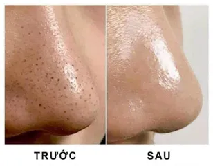 (Có tem) BHA 2% ngừa mụn, giảm dầu nhờn, thu nhỏ lỗ chân lông Obagi
