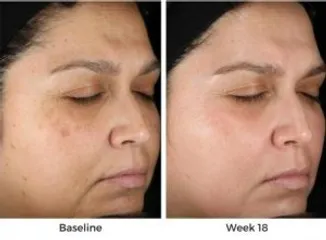 Kem Trị Nám Obagi Nu-Derm Blender #5 Rx - Dưỡng Da Cấp Ẩm, Tái Tạo, Giúp Làm Sáng Da Cho Tất Cả Các Loại Da
