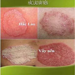 Kem Bôi Bọ Cạp Vàng Trị Nấm Ngứa Hắc Lào - Sản Phẩm Tự Nhiên Hiệu Quả Với Đảm Bảo Hoàn Tiền 100%