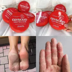Kem Giảm Nứt Nẻ Gót Chân Glysolid Hautbalsam Đức 100ml