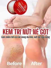 Kem Giảm Nứt Nẻ Gót Chân Glysolid Hautbalsam Đức 100ml
