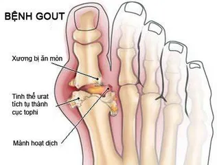 Hỗ trợ điều trị bệnh gout