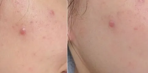 Ảnh đánh giá Kem chấm mụn Jean D'Arcel Blemish Control 30ml - Giảm sưng, xẹp mụn nhanh chóng, sản phẩm chăm sóc da mụn hiệu quả từ Đức