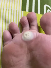 Ảnh đánh giá Miếng Dán Lột Mụn Cóc Ibokorori Nhật Bản 12 Miếng - Giải Pháp Làm Sạch Mụn Cóc & Vết Chai Cho Da Mịn Màng