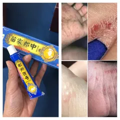 Kem Bôi Đông Y Chữa Nấm Ngứa 15g - Hiệu Quả Nhanh Chóng, Điều Trị Viêm Da, Dị Ứng và Nấm Tay Chân