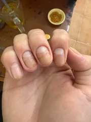 Ảnh đánh giá Dung Dịch Chấm Nấm Móng Ciclopirox 8% - Giải Pháp Hiệu Quả Ngăn Ngừa Nấm Móng Cho Chân Và Tay, Dưỡng Ẩm & Tái Tạo Móng Khỏe Mạnh