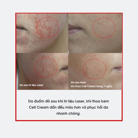 Kem Dưỡng Da Sau Laser Histo Cell Cream - Hỗ Trợ Làm Lành Da, Bảo Vệ Sẹo, Phục Hồi Da Tổn Thương - Dành Cho Tất Cả Loại Da 50ml
