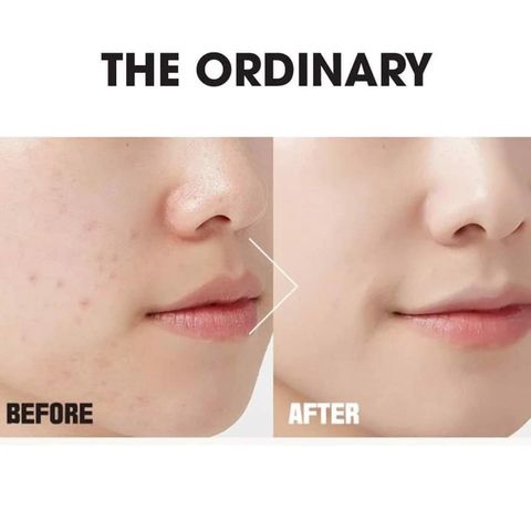 Serum Nia-cinamide 10% + Zinc 1% The Ordinary - Kiềm dầu, giảm mụn, làm sáng da, điều tiết dầu thừa, 30ml, sản phẩm chăm sóc da chất lượng cao