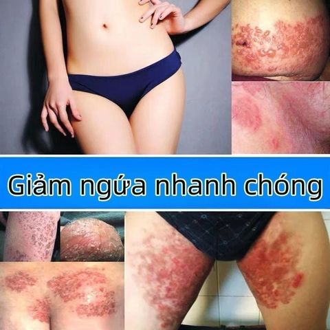 Kem Bôi Đa Năng Nhật Bản Giảm Ngứa - Hỗ Trợ Điều Trị Nấm Da, Hắc Lào, Vảy Nến, Tổ Đỉa - An Toàn Cho Mọi Loại Da