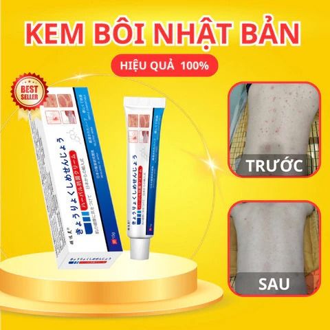 Kem Bôi Đa Năng Nhật Bản Giảm Ngứa - Hỗ Trợ Điều Trị Nấm Da, Hắc Lào, Vảy Nến, Tổ Đỉa - An Toàn Cho Mọi Loại Da