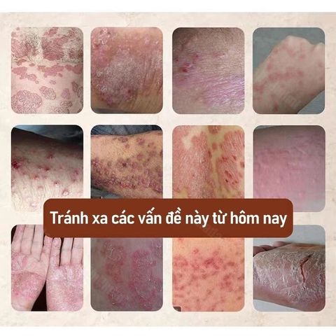 Kem Bôi Đa Năng Nhật Bản Giảm Ngứa - Hỗ Trợ Điều Trị Nấm Da, Hắc Lào, Vảy Nến, Tổ Đỉa - An Toàn Cho Mọi Loại Da