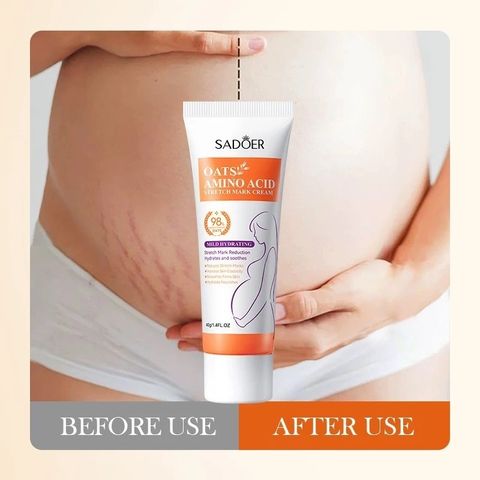 Kem Làm Mờ Rạn Da Anti-Stretch Marks Cream Cho Bà Bầu - Giúp Tái Tạo Da, Giảm Sẹo và Thâm, An Toàn Cho Làn Da Nhạy Cảm