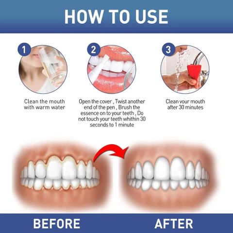 Bút Tẩy Trắng Răng Nha Khoa TEETH Whitening Pen - Giúp Làm Sạch Mảng Bám, Răng Trắng Sáng Tự Nhiên, Tiện Lợi và An Toàn