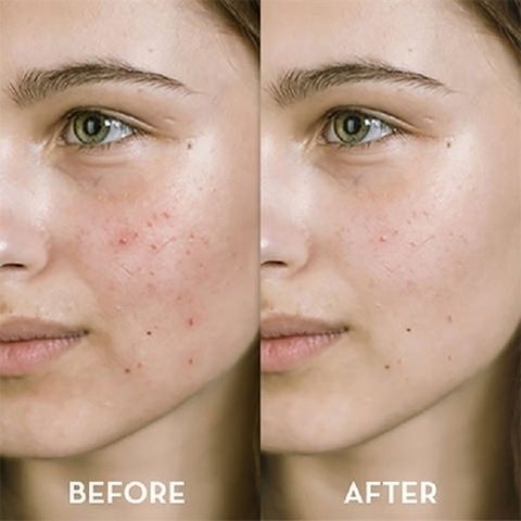 Kem Chấm Mụn Neutrogena On The Spot 21g - Điều Trị Mụn Hiệu Quả, Giảm Sưng Đỏ, An Toàn Cho Da