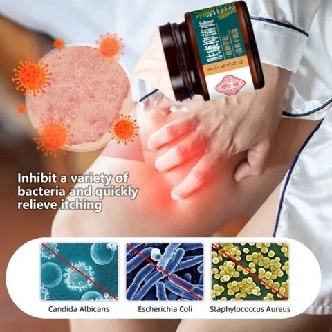 Kem chống ngứa kem kháng khuẩn chống dị ứng khỏi tận gốc viêm da bệnhh chàm Ngứa da nấm da nấm mụn nước tổ đỉa 30g