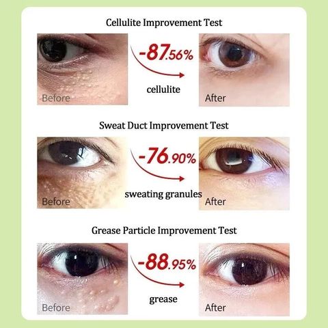 Mụn Thịt Quanh Mắt - Kem Mắt Vitamin E Nguyên Chất Giảm Thâm, Xóa Nhăn, Căng Bóng