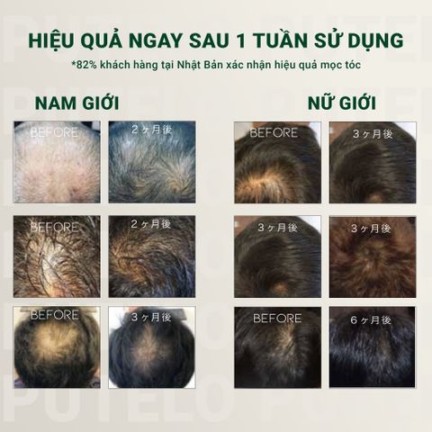 Bộ dầu gội & xả thực vật, trẻ hóa da đầu, giảm rụng, hỗ trợ mọc tóc – Putelo AR – Chính hãng Nhật Bản