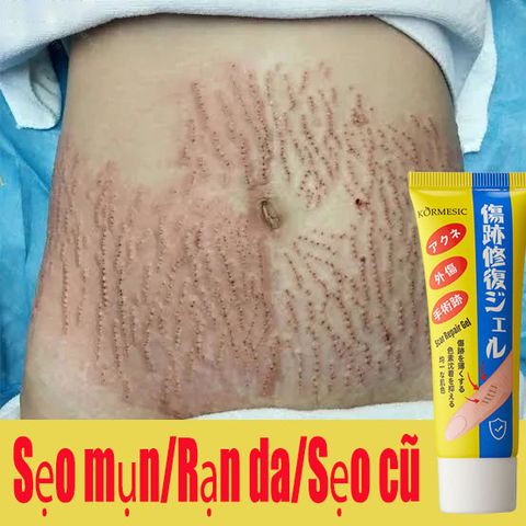 Kem sẹo kem mờ sẹo kem bôi sẹo mờ sẹo 40g kem mờ sẹo thâm mờ thâm sẹo kem liền sẹo loại bỏ sẹo mụn trứng cá