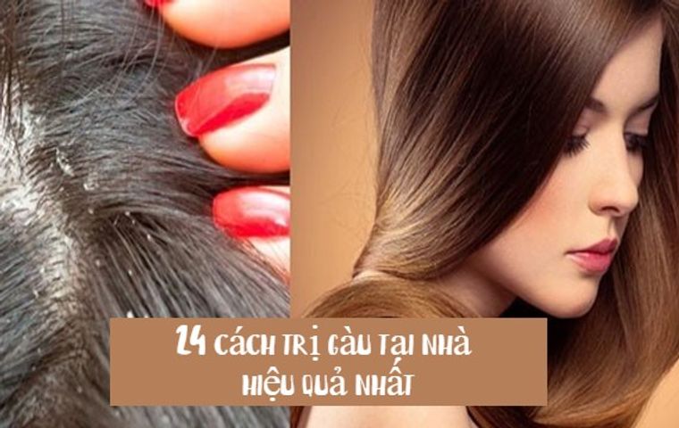 24 cách trị gàu tại nhà hiệu quả với nguyên liệu dễ kiếm
