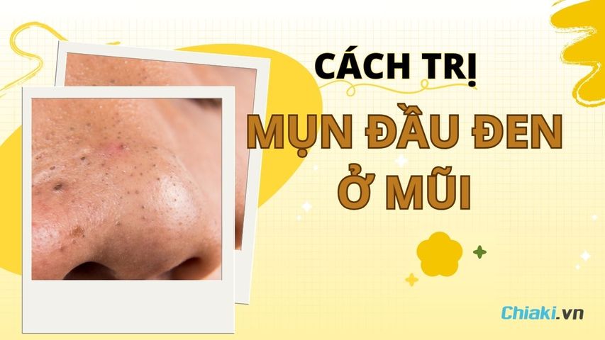 Top 10 Cách trị mụn đầu đen ở mũi hiệu quả và ngăn ngừa tái phát