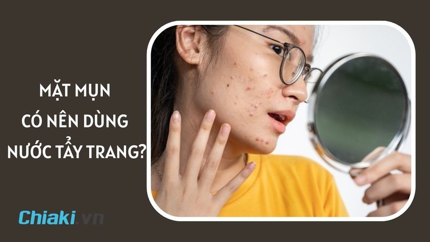 Mặt mụn có nên dùng nước tẩy trang không? Lưu ý khi sử dụng