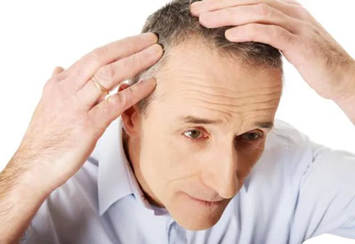 Rụng tóc nhiều là bệnh gì? Cách khắc phục rụng tóc ở nữ và nam