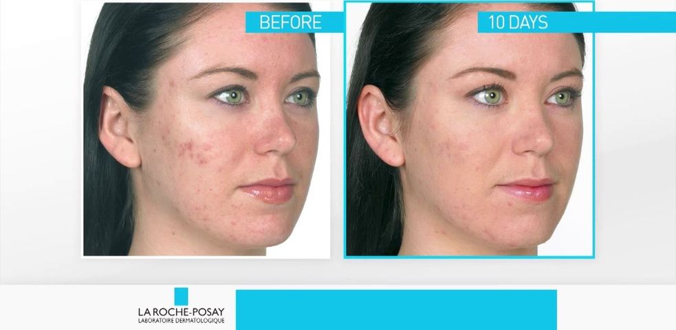 Kem Trị Mụn La Roche Posay Effaclar Duo+ 40ml - Giúp Làm Sạch Da, Ngăn Ngừa Mụn Hiệu Quả Với Niacinamide và LHA