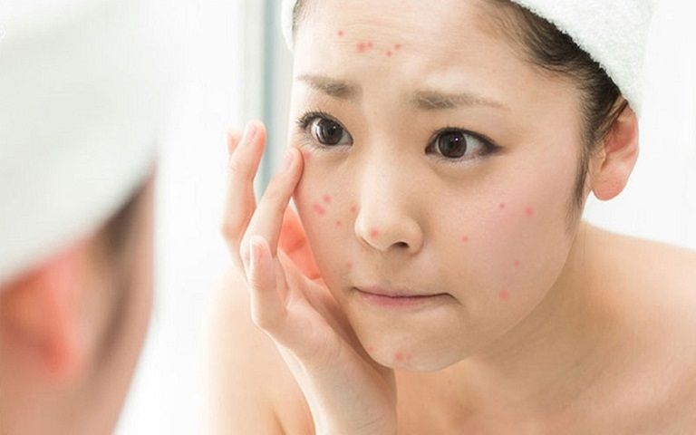 Kem Trị Mụn T Gel 1% Nhật Bản - Hỗ Trợ Giảm Sưng Đỏ, Cải Thiện Mụn Bọc, Mụn Trứng Cá, 10g Sato Chính Hãng