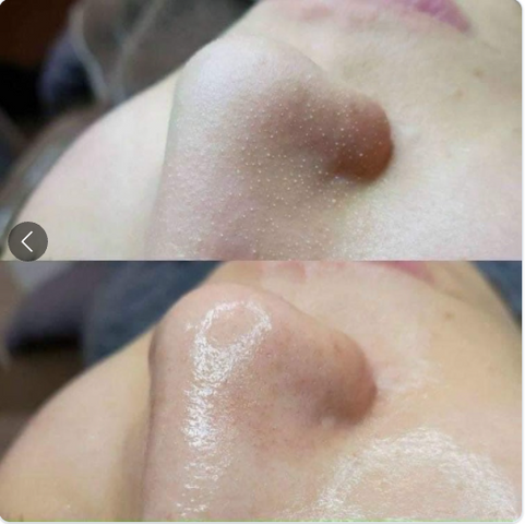Ủ Mụn Đầu Đen Remove Blackheads 50ml - Chăm Sóc Da Mặt Làm Sạch Sợi Bã Nhờn, Giải Pháp Tận Gốc Cho Da Mụn