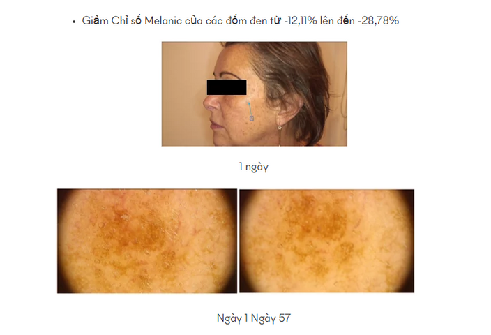 Serum Ivawhite Chuyên Sâu Giảm Nám - Làm Sáng Da Hiệu Quả 30ml, Phù Hợp Mọi Loại Da, Giải Pháp Cho Da Nám Tàn Nhang.