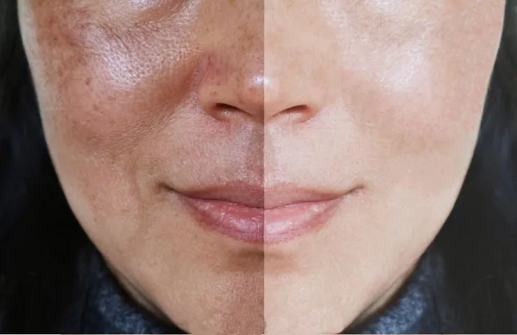 Dung dịch thay da sinh học Md:ceuticals Md Peel Azelaic 17% & Salicylic 20% - Serum cải thiện sắc tố da, giảm mụn và lão hóa da
