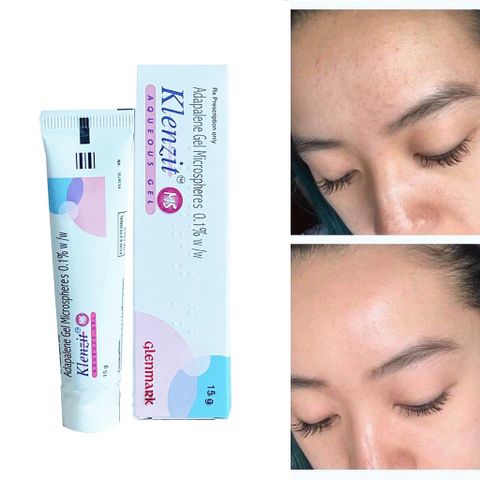 Gel Trị Mụn Klenzit MS 15g - Hỗ Trợ Giảm Mụn Trứng Cá và Mụn Ẩn, Làm Sáng Da và Ngăn Ngừa Viêm, Chính Hãng Glenmark