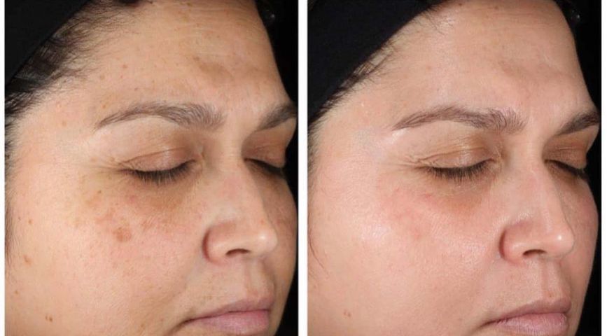 Kem Dưỡng Obagi Retinol 1.0 - Giảm Nhăn, Trẻ Hóa Da, Dưỡng Sáng Da, Hỗ Trợ Cải Thiện Mụn - 28g Chính Hãng