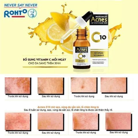 Serum Acnes Vitamin C 15ml - Tinh Chất Làm Mờ Sẹo & Vết Thâm - Giải Pháp Cho Da Sáng Mịn Màng, Đánh Bật Sẹo Mụn