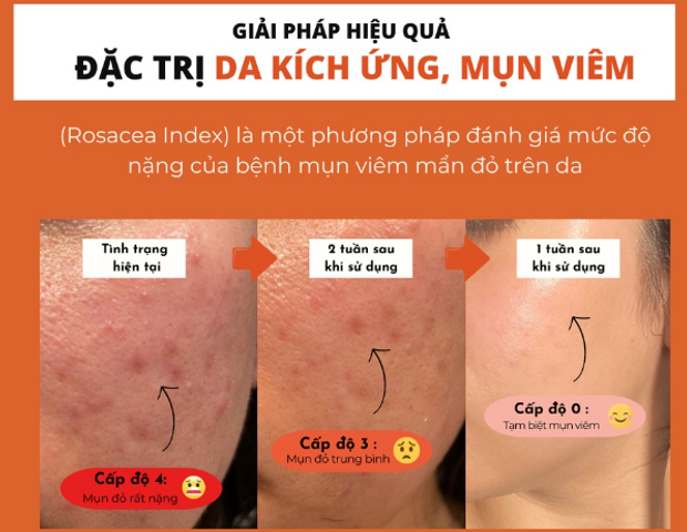 Toner Pad Bellamonster Carrot - Dành cho Da Mụn & Nhạy Cảm, Giúp Làm Dịu, Cải Thiện Tình Trạng Mụn, An Toàn & Hiệu Quả