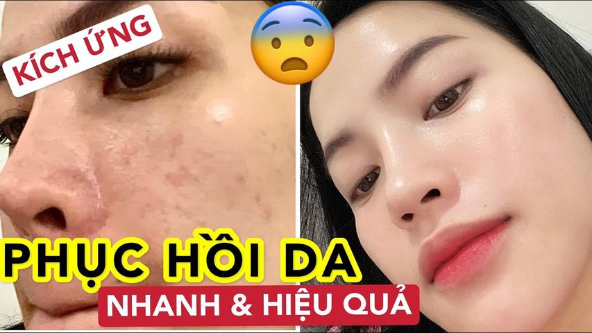 Kem phục hồi da Radiance Beauva Azelaic 30 Zinc PCA+ - Giảm mụn, làm dịu kích ứng, hỗ trợ cho mọi loại da 30ml