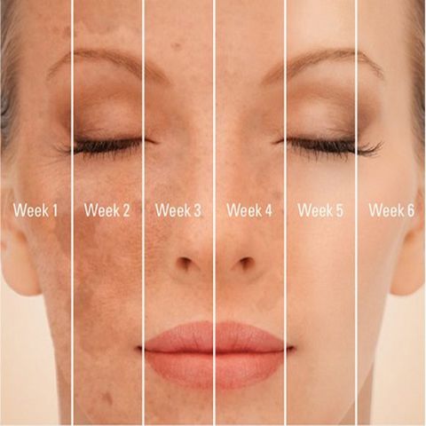 Kem Giảm Nám Trắng Da SkinMD Hàn Quốc 15ml - Giải Pháp Chống Lão Hóa, Làm Sáng Da, Phục Hồi Tổn Thương Da