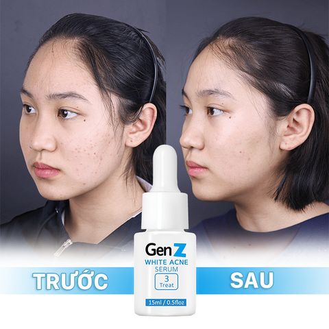 Serum OriSkin  GenZ White Acne Ngừa mụn xoá thâm giúp sáng da