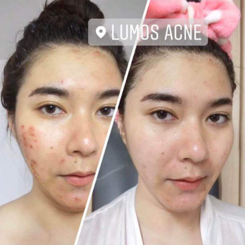 Serum Ngăn Ngừa Mụn Lumos Acne 5ml - Giảm Thâm, Dưỡng Da Sáng Khỏe Mạnh Cho Da Nhạy Cảm, Hỗ Trợ Trị Mụn Tự Nhiên