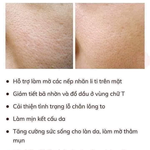 Serum Niacinamide 10% + Kẽm 1% - Dưỡng trắng, se khít lỗ chân lông, tái tạo da mịn màng - Balea