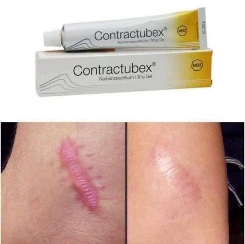 Kem Hỗ Trợ Chống Sẹo Contractubex 30g - Giúp Làm Mờ Sẹo, Giảm Viêm, Làm Lành Vết Thương Nhanh Chóng, Xuất Xứ Đức