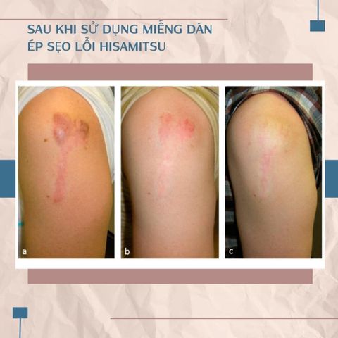 Miếng dán sẹo lồi nội địa Nhật Bản - Hisamitsu