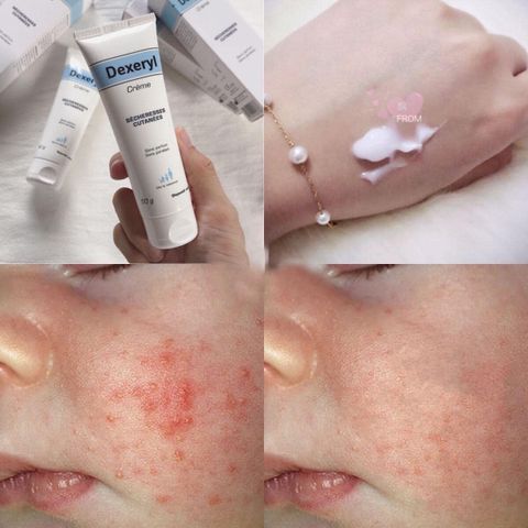 Kem nẻ, chàm da, dưỡng ẩm Dexeryl nội địa Pháp