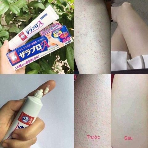 Kem hỗ trợ giảm viêm nang lông Zaraporo Rohto 35g - Nhật Bản