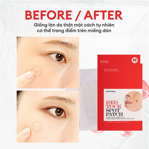 Miếng Dán Mụn So'Natural Red Tock Spot Patch