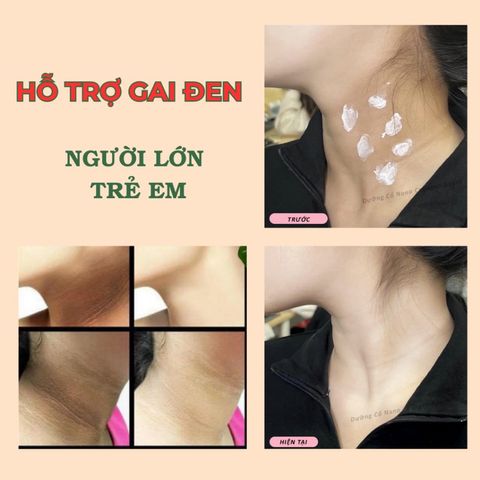 Kem Dưỡng Da Cổ Loka Nano 50ML - Chống Nhăn, Phục Hồi Da Cổ, Bảo Vệ Da, SPF 30+ - Dưỡng Ẩm, Căng Mịn Làn Da Tươi Trẻ