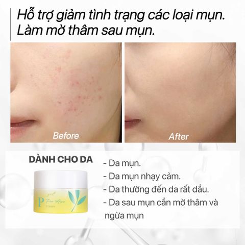 Kem Dưỡng Da Mụn Trà Nghệ GUO - Pro Acne Cream 30g, Kích Thích Làm Dịu Da, Ngăn Ngừa Mụn Tái Phát