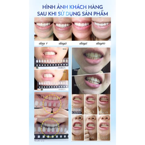 Miếng Dán Làm Trắng Răng Anriea Than Tre - Không Gây Ê Buốt, Dễ Dàng Sử Dụng Tại Nhà, Giúp Sáng Răng Tự Nhiên